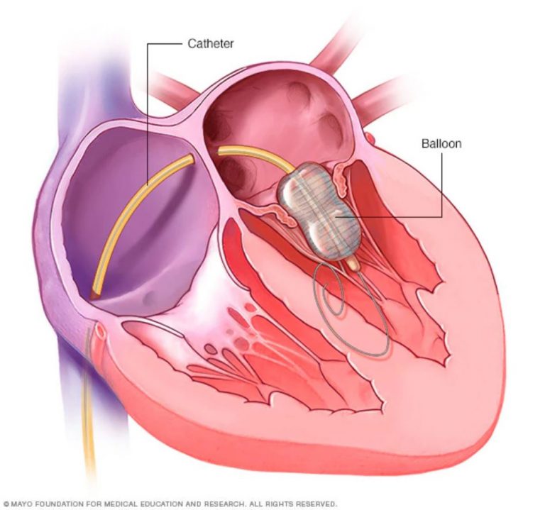 LOOK Polymedic Accomplishes First Ever Balloon Mitral Valvotomy